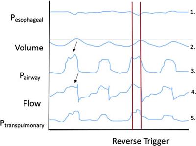 Reverse Triggering: An Introduction to Diagnosis, Management, and Pharmacologic Implications